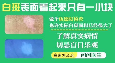 白斑ZUI初期好治吗 白斑怎么治疗好