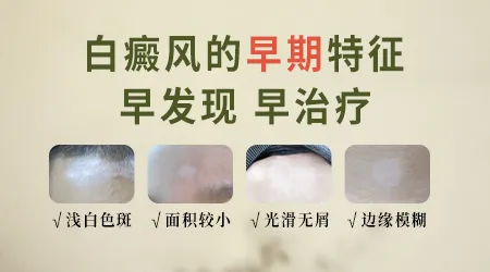 白癜风早期症状图片与分析 医生拆解早期白斑识别逻辑
