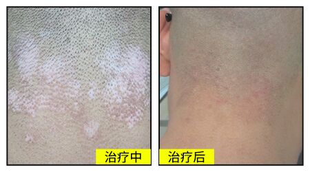 白癜风毛发变白能恢复吗