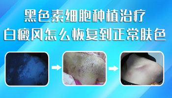 黑色素细胞移植之后白斑部位比正常皮肤黑
