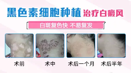 白癜风植皮过还是白白的