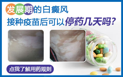 白癜风处于治疗阶段接种疫苗可以吗