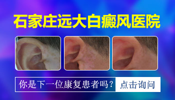 311和308灯哪个用于白癜风好