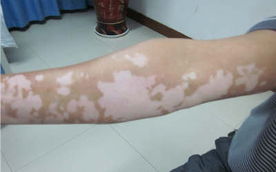 手臂皮肤白色点点图片