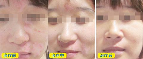 白癜风到底能不能治好 收费会不会特别贵