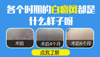 怎样知道白癜风属于什么时期