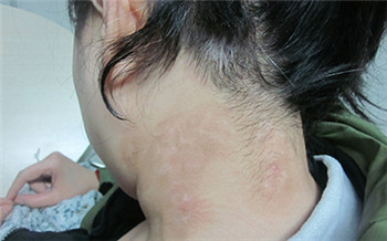 小孩脖子白斑早期症状图片