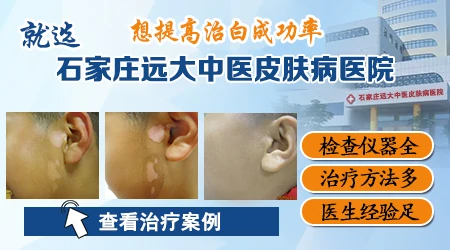 石家庄看白斑去哪个医院靠谱