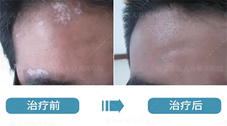 邢台哪家医院能治好白癜风