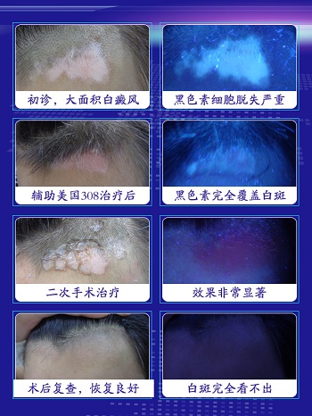家用308照白癜风有效果吗