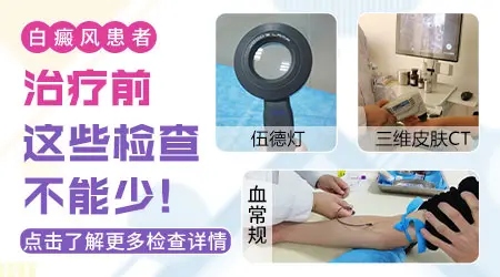 伍德灯检查淡白色 白癜风在伍德灯下症状