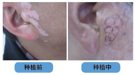 面部白癜风移植后十天的照片
