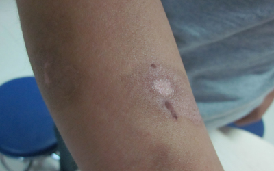 接种新冠疫苗后胳膊出现白斑