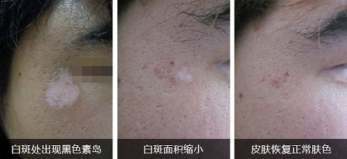 白斑处长黑点后多久可彻底好