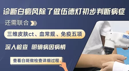 早期白癜风用伍德灯照什么颜色