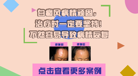 为什么白癜风治疗半个月没变化