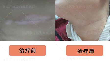 白斑一定要激光吗 哪种光疗照白癜风好