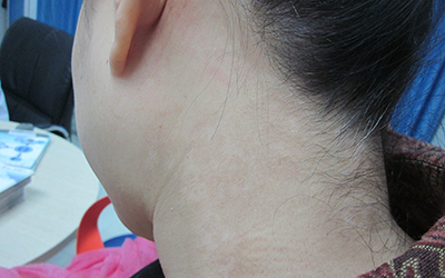 后颈长白斑是什么原因造成的