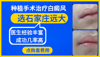 石家庄哪里做黑色素种植好 白癜风能治好吗