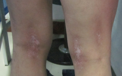 大腿根里边白了一块是什么原因