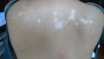 背部白色斑点图片 治疗白斑的方法是什么