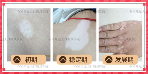 伤口结痂为什么会泛白图片