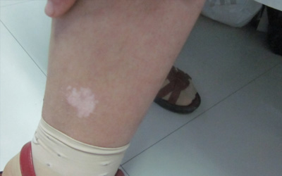 右脚脚踝处有明显的白点是怎么回事