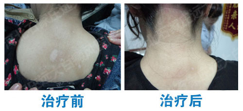 石家庄激光治疗白癜风的效果图