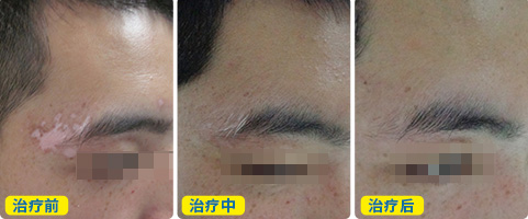 白癜风导致的毛发也变白了还能治疗好
