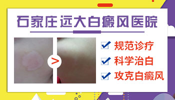 肢端型白癜风会长满全身吗