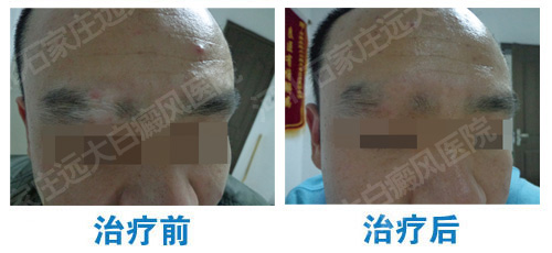 眉毛部位白癜风案例图片