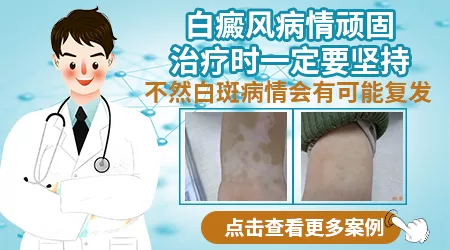 白癜风ZUI初期的症状图片