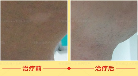 就一小块白癜风能治好吗