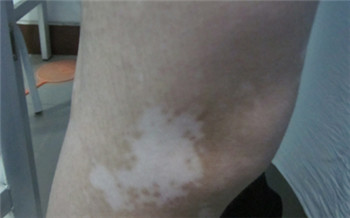 胳膊肘白斑一年多了没变化是不是白癜风