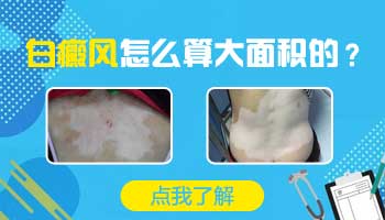 稳定期白癜风表皮移植面积大需要做几次