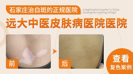 脸上有块白斑但不是很白可能是什么