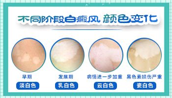 怎么才知道白癜风是哪个阶段