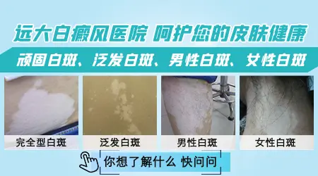 白癜风做完植皮就可以出院了吗
