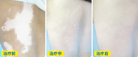 全国治疗白癜风ZUI好的医院