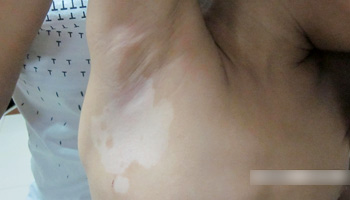 腋下一片发白是怎么回事