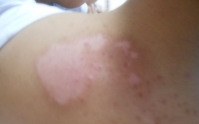 女性肩膀上长了白色的小点点