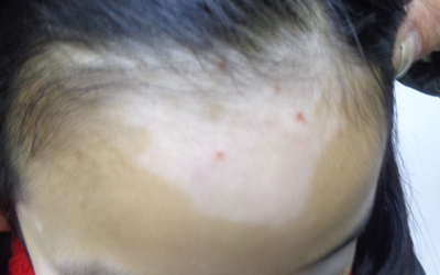 儿童白癜风治愈案例