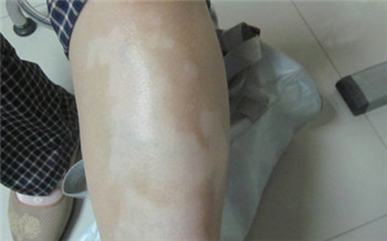宝宝大腿上有白斑图片