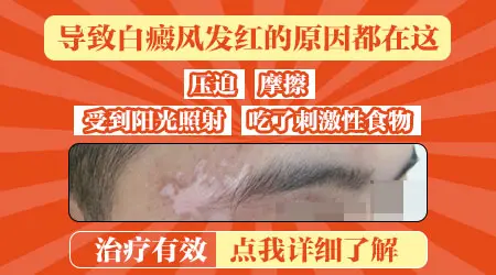 白癜风泛红是要恢复吗