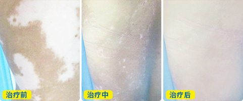 白癜风病情在恢复时是怎样的