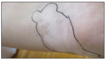 新生儿婴儿白癜风图片