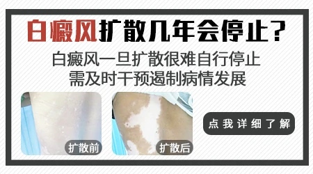 白癜风用他克莫司越抹越大怎么回事