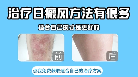 治身上白斑的方法 白癜风治疗案例