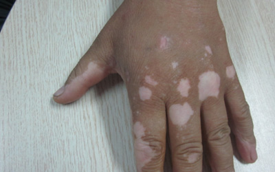 艾叶泡水治手部白癜风有效果吗