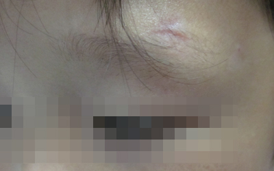 眉毛部位的皮肤发白最近还变大了怎么回事